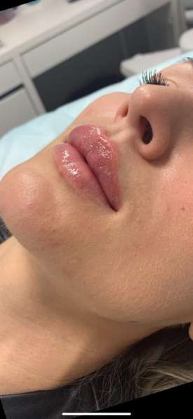 Увеличение губ в Мытищи фото 3