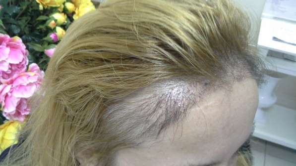 Решение проблемы выпадения волос, активация роста волос в Волгограде фото 4
