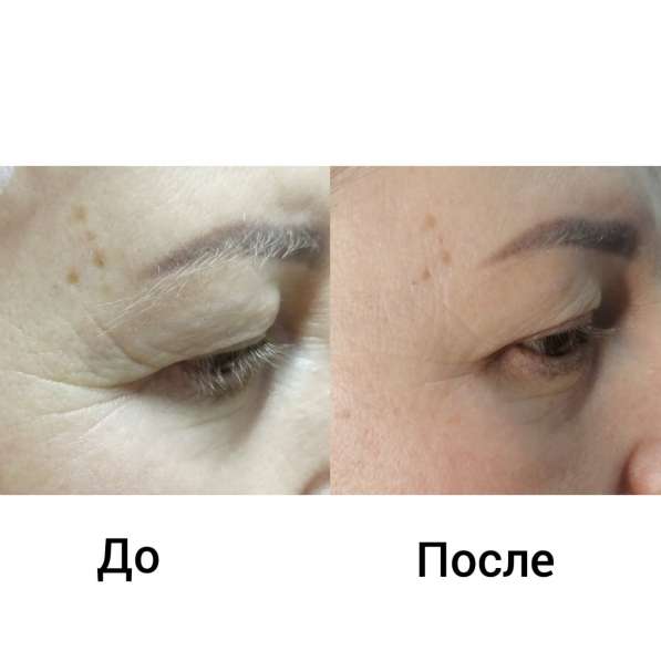 Депиляция, педикюр,подолог,антицеллюлитн.массаж,лифтинг лица в Иркутске фото 6