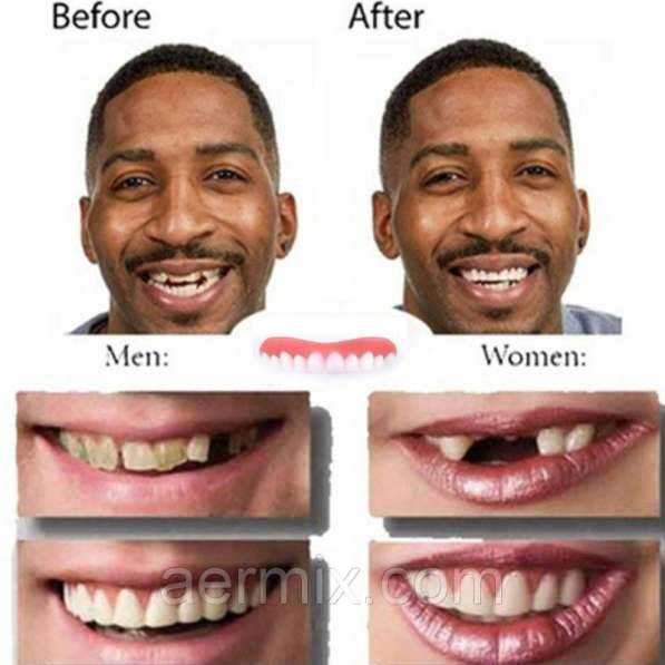 Виниры smail Perfect-накладные зубы