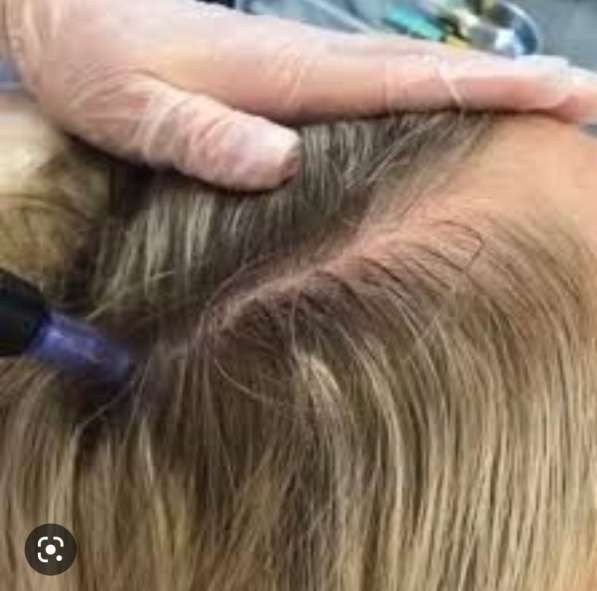 Мезотерапия волос от выпадения в Москве фото 5
