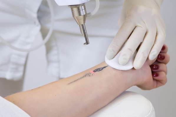 Обучение лазерному удалению татуажа и татуировок