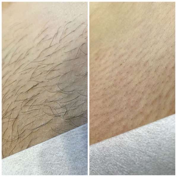 Депиляция - шугаринг, воск в Грозном фото 4